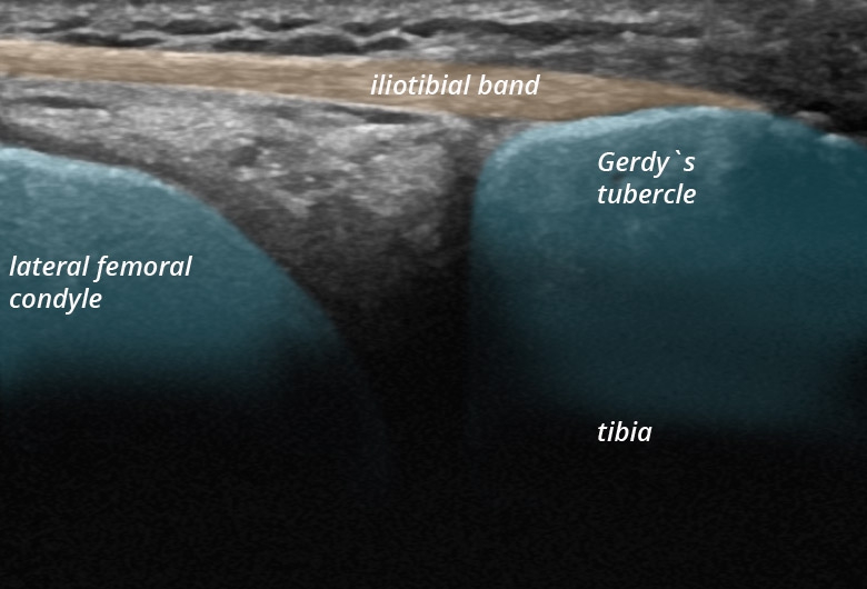 Knee lateral iliotibial band longitudinal