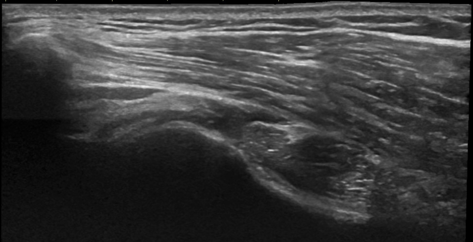 Sonogram: Shoulder posterior infraspinatus transverse