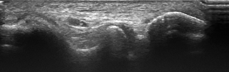 Elbow posterior sulcus n ulnaris transverse