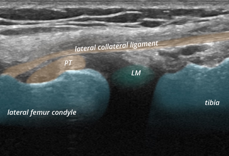 Knee lateral collateral ligament cranial longitudinal