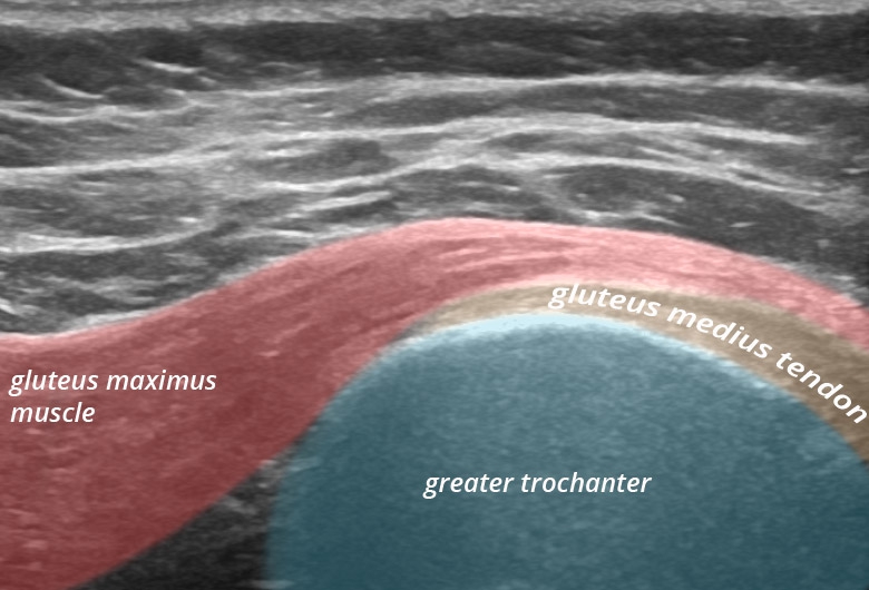 Pelvis lateral trochanter major abductors transverse