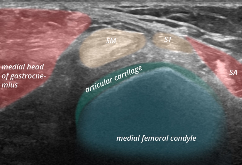 Knee posterior medial tendons transverse