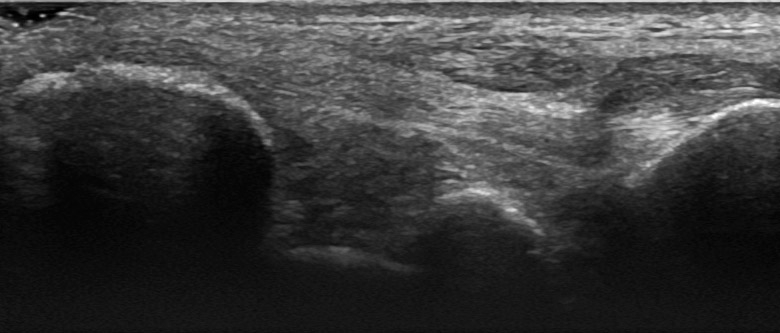 Foot Ankle medial ligaments tibiocalcanear