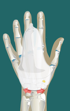 Aspiration of peritendinous effusion | SonoTool®