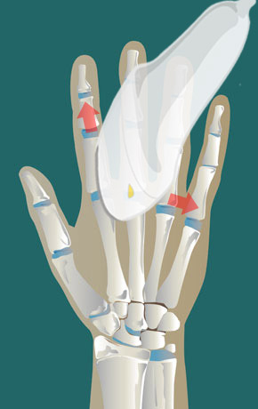 [CPPD] MCP joints arthropathy | SonoTool®