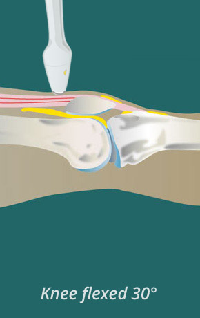 Injection of the knee | SonoTool®