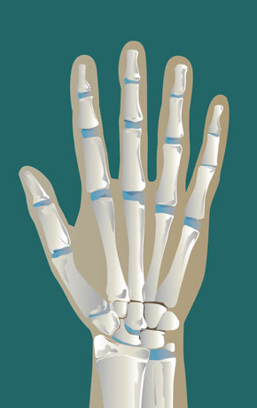 Tenosynovitis Of The Flexor Tendons | SonoTool®