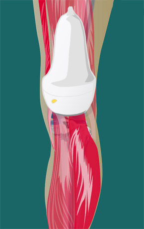 Posterior cruciate ligament – longitudinal | SonoTool®