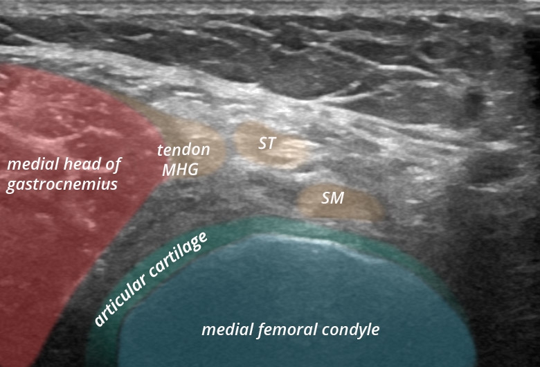 Semimembranosus Bursitis