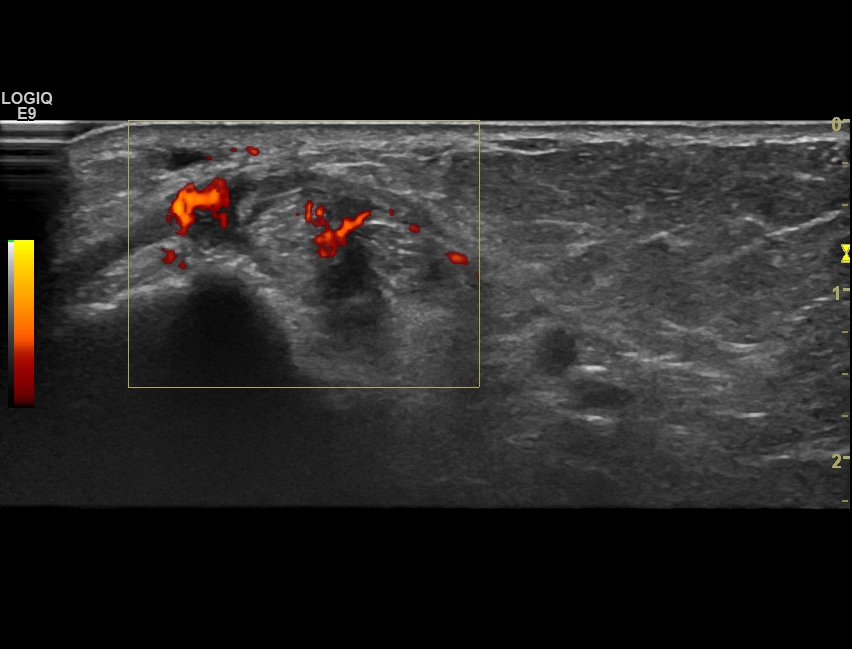 Tenosynovitis tibialis posterior and flexor digitorum longus tendon ...