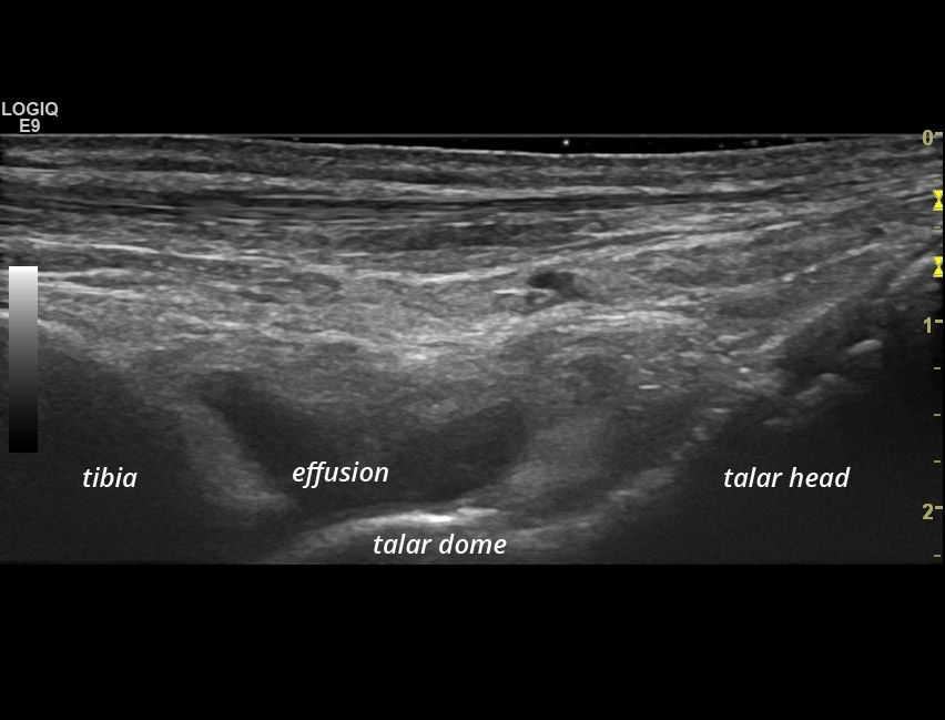 [SpA] Ankle Synovitis | SonoTool®