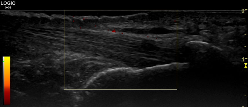 Subcutaneous calcaneal bursitis | SonoTool®