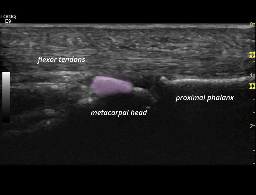 [CPPD] MCP joints arthropathy | SonoTool®