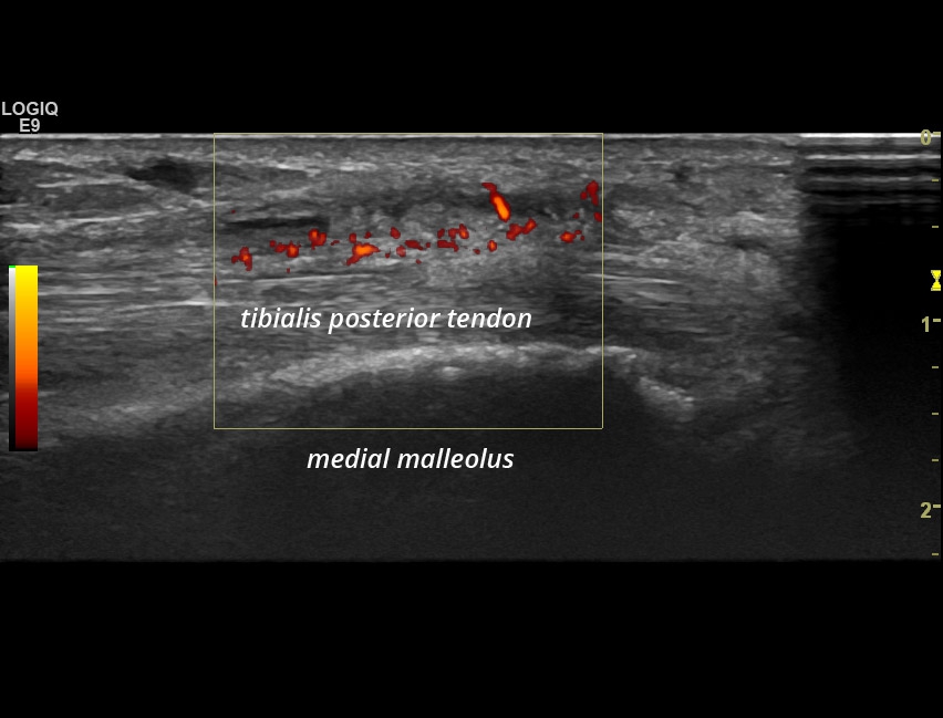 Tenosynovitis Tibialis Posterior And Flexor Digitorum Longus Tendon ...