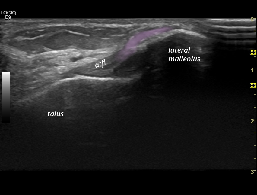 Injury Of The Talofibular Ligament After Ankle Distorsion 