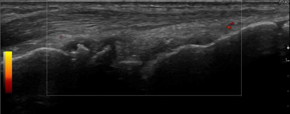 [CPPD] Osteophytes radiocarpal joint | SonoTool®