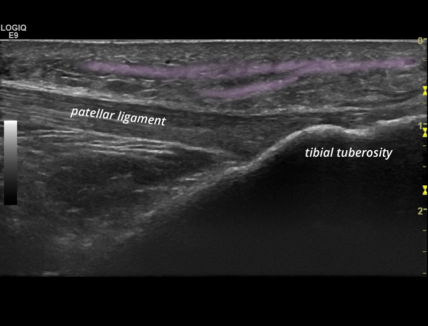 Subcutaneous infrapatellar bursitis | SonoTool®