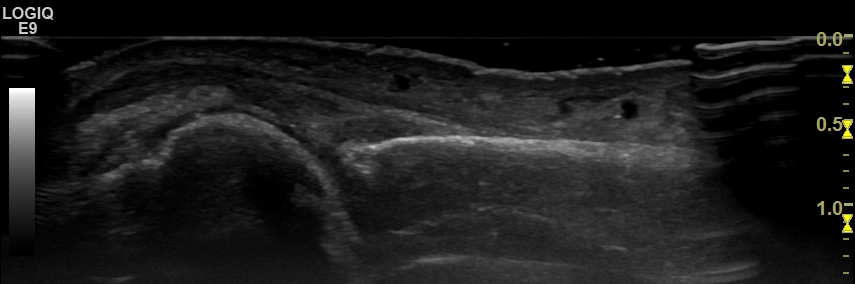 Gouty arthropathy | SonoTool®