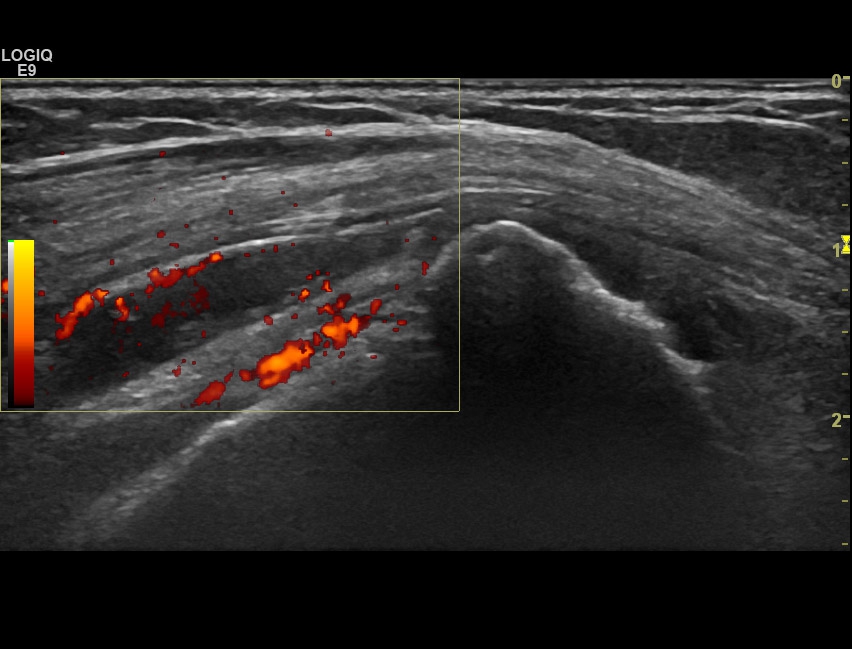 Tears: Supraspinatus | SonoTool®