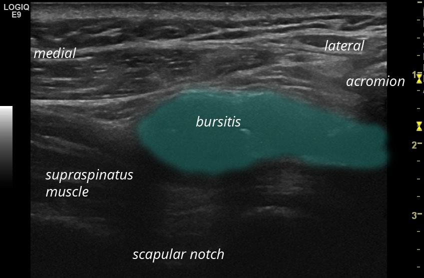 Subacromial subdeltoid bursitis | SonoTool®