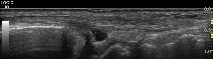[CPPD] Ganglion cyst extensor carpi ulnaris tendon | SonoTool®